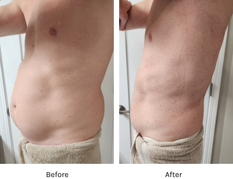 Semaglutide Before & After at JK MedSpa Columbus NE