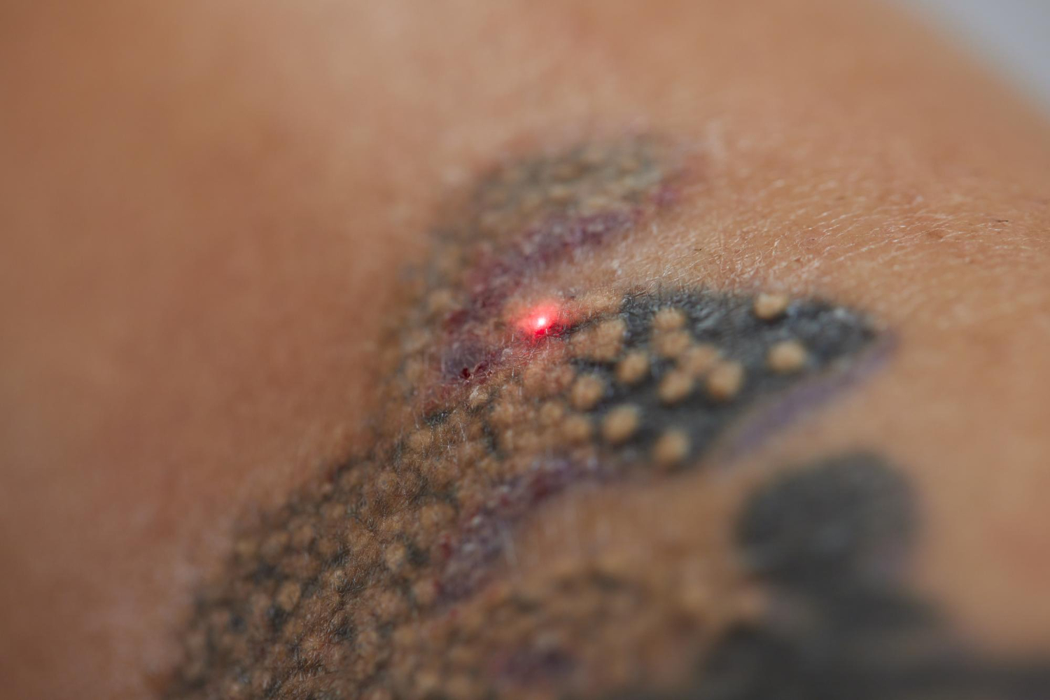 Laser Tattoo Removal
