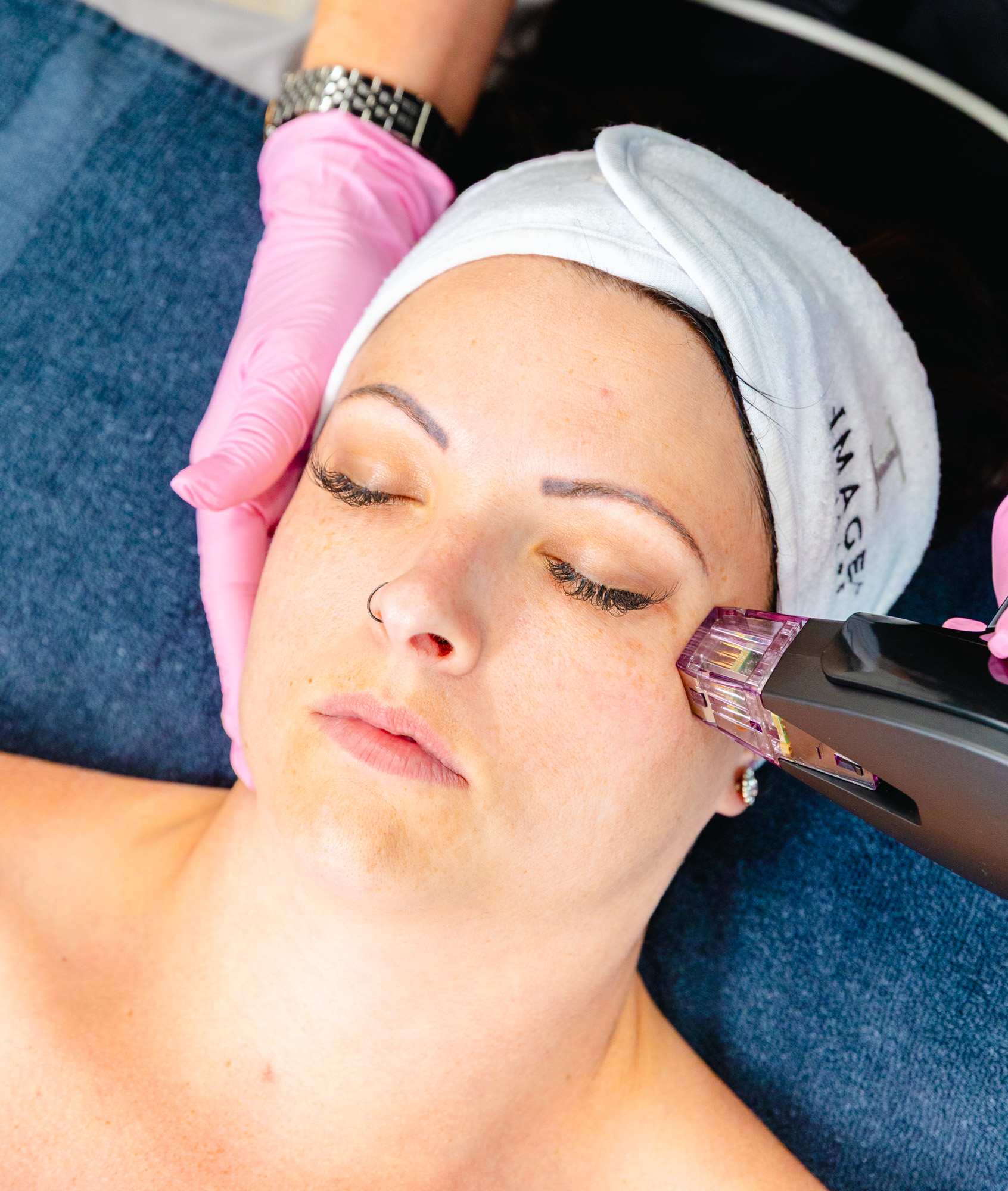 Morpheus8 RF Microneedling